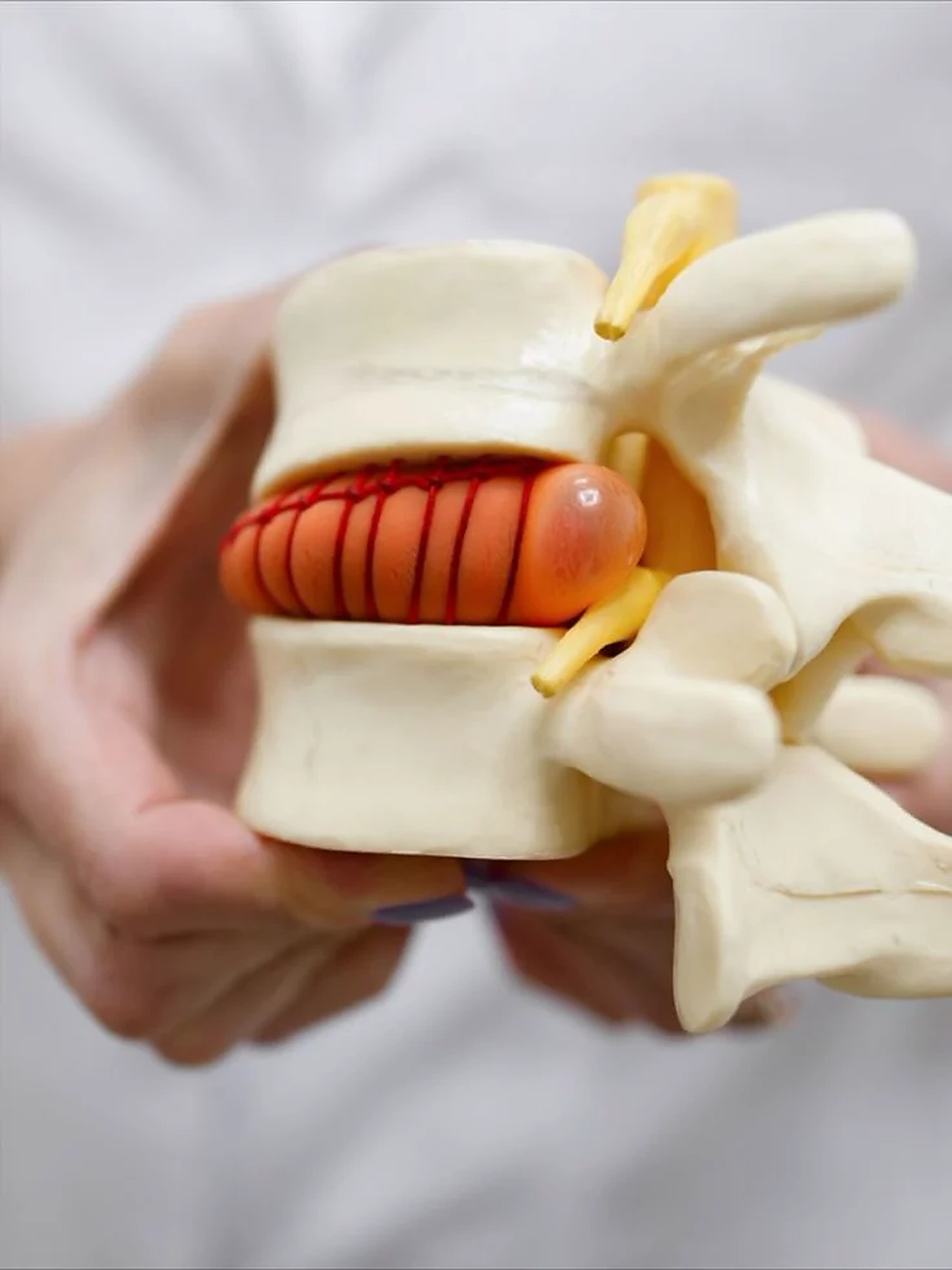 Hernia discal: síntomas, diagnóstico y tratamiento integral en CRI Rambla